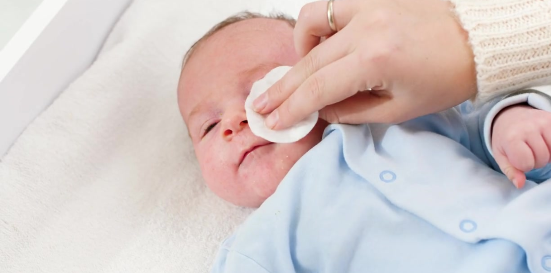 A conjuntivite neonatal (CN) é uma infecção ocular que acomete a conjuntiva de bebês no prazo de 24 horas até um mês após o nascimento.